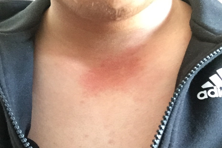 局部摩擦胸口皮肤发红图