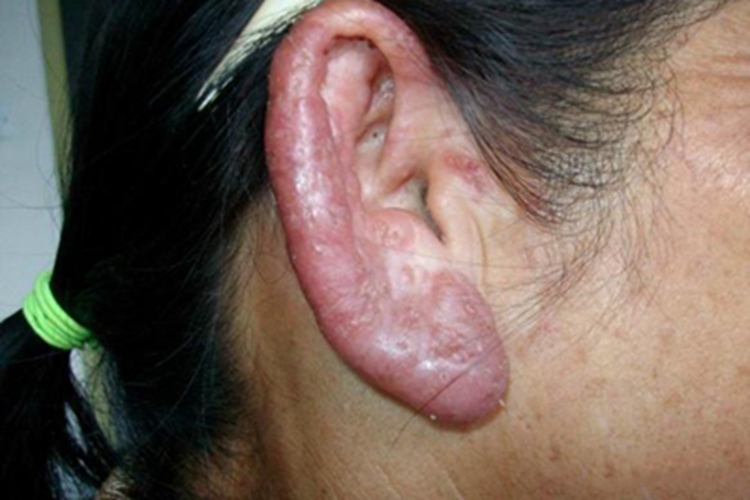 寻常狼疮耳部肿的发红图 寻常狼疮耳部肿的发红图