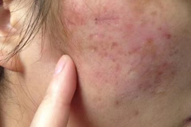 深在性红斑狼疮小坑图