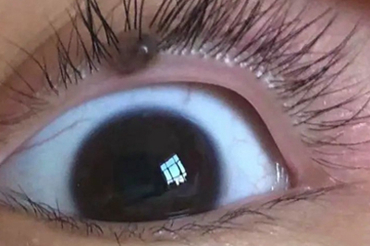 眼睑皮内痣症状图