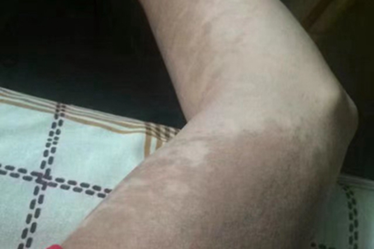 色素型胎记胳膊斑图