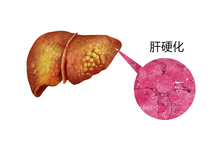 肝硬化图