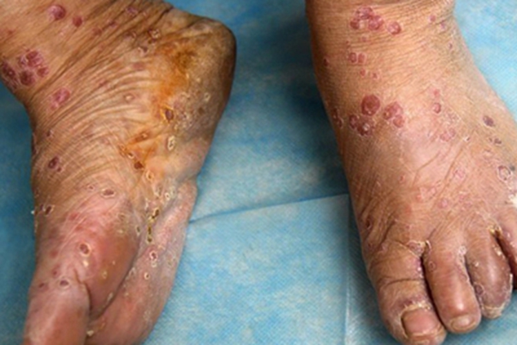 男性三期梅毒脚部红斑图 男性三期梅毒脚部红斑图