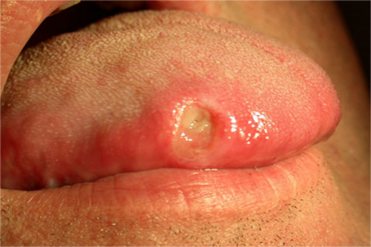 重型阿弗他溃疡舌侧溃疡图