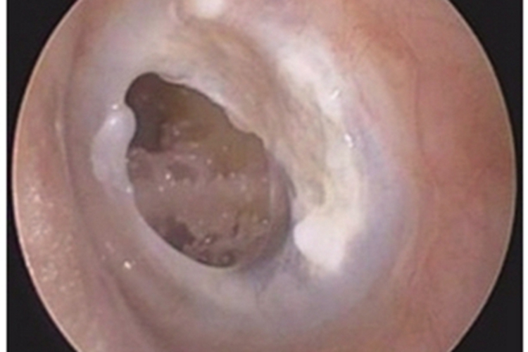 化脓性中耳炎鼓膜大窟窿图