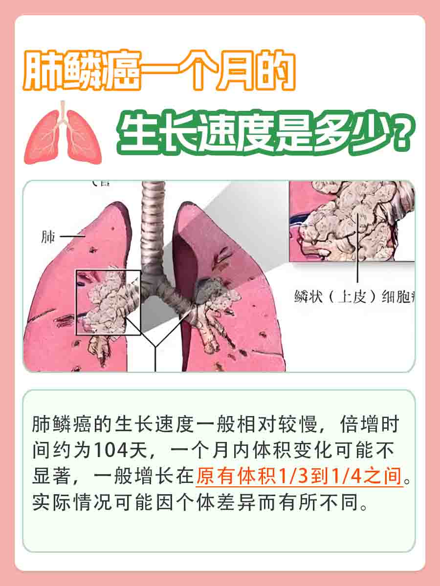 肺鳞癌一个月的生长速度是多少，你知道吗？