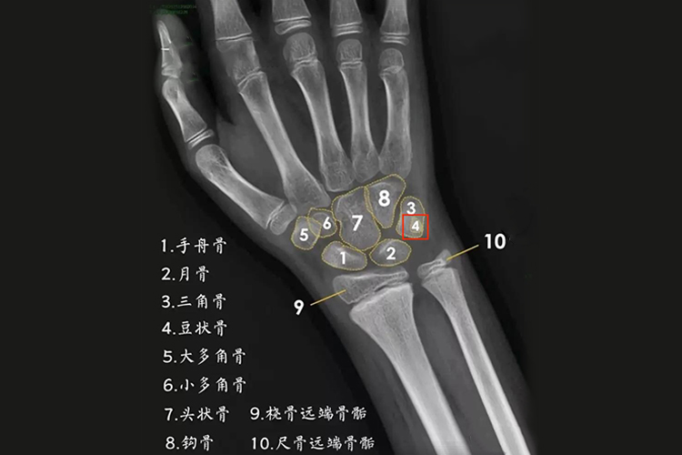 手腕豆状骨影像图