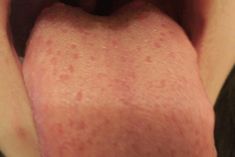 小孩舌根部舌乳头炎图