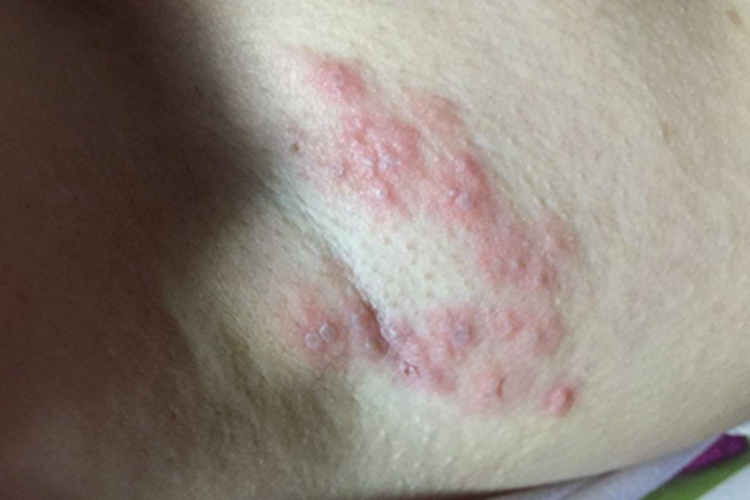 革螨皮炎腋窝红色丘疹图 革螨皮炎腋窝红色丘疹图