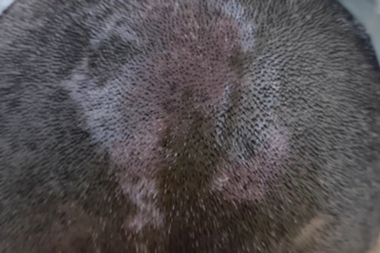 白癜风头部长斑图