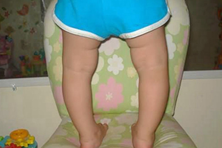 维生素D依赖性佝偻病症状图 维生素D依赖性佝偻病症状图