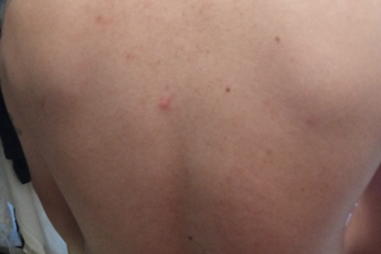 毛囊炎背部长一个小红疙瘩图