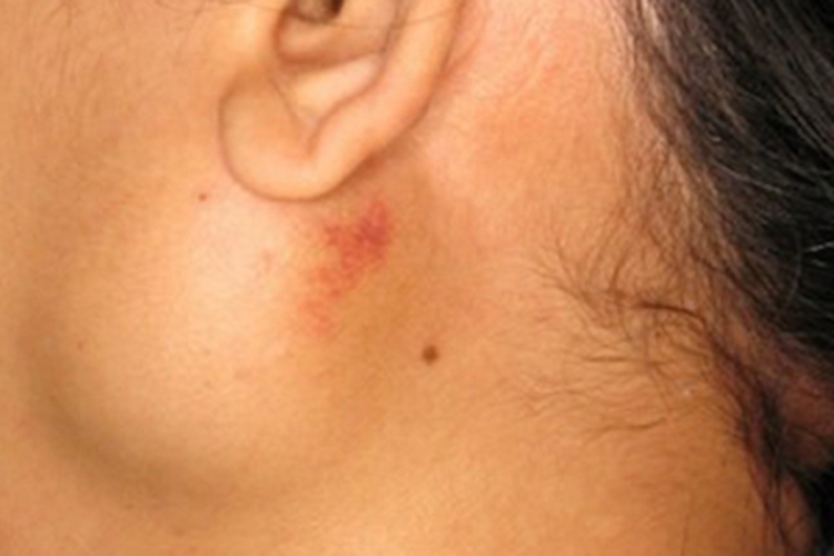 腮腺皮样囊肿症状图 腮腺皮样囊肿症状图