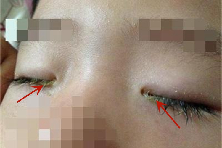 眼睑淋病双眼有黄痂图