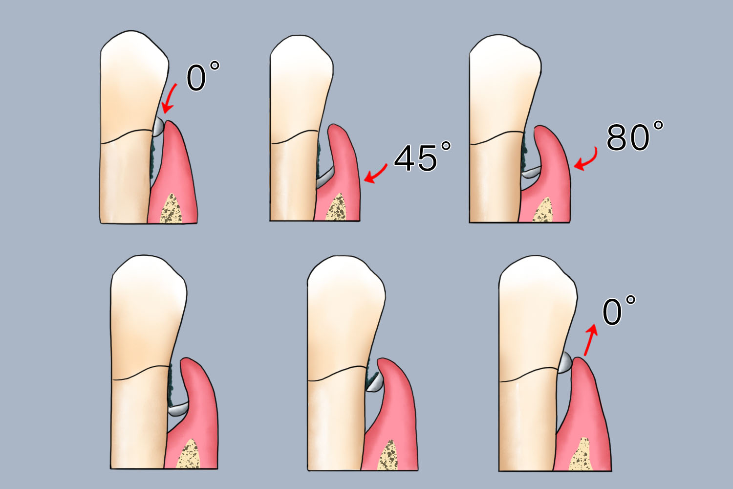 牙周龈下刮治和根面平整操作图 牙周龈下刮治和根面平整操作图
