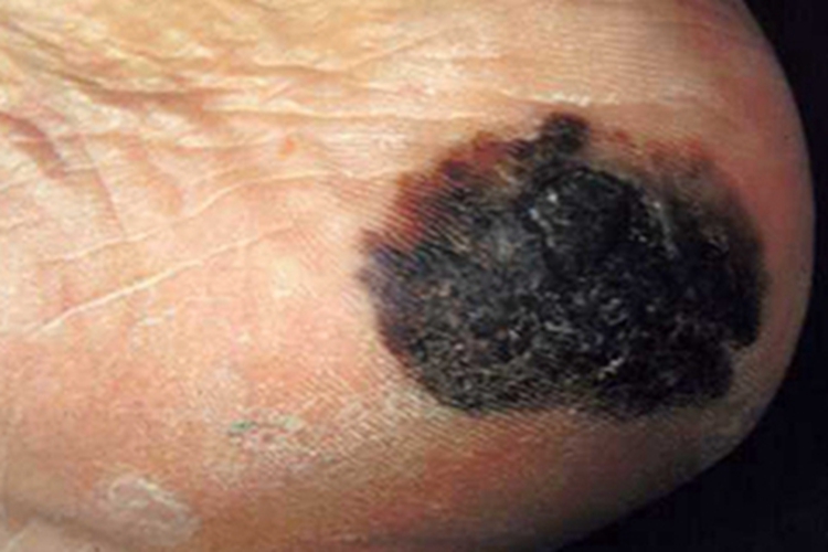 浅表播散型黑色素瘤脚后跟症状图
