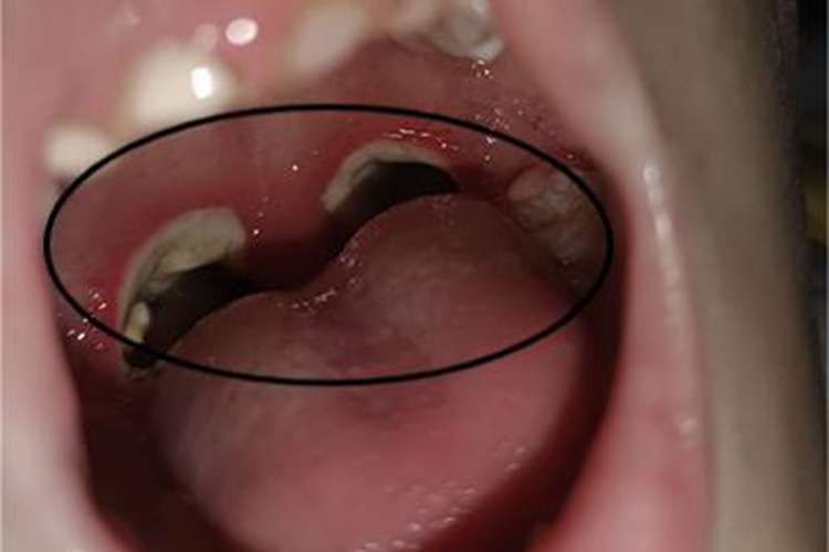 化脓性扁桃体炎咽喉化脓图