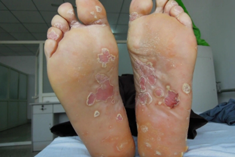 脓疱性肢端皮炎脚底症状图 脓疱性肢端皮炎脚底症状图