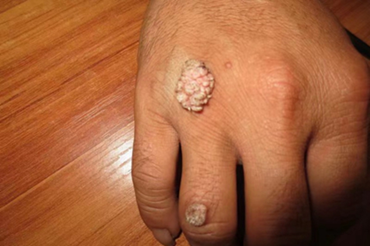 寻常疣手背症状图