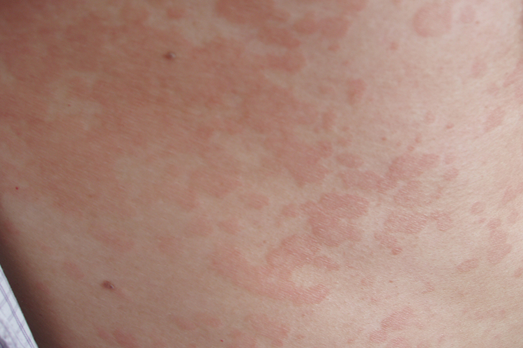 淡红色花斑癣图