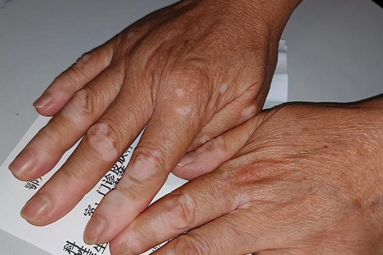 手部老年性白斑图