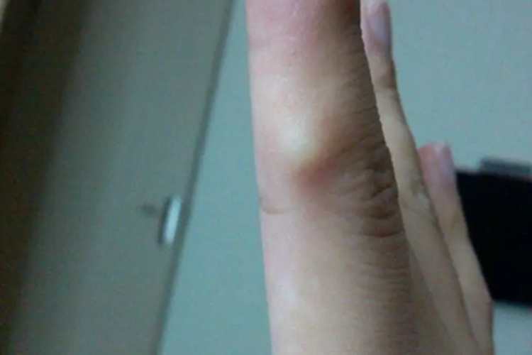 毛发囊肿手部症状图