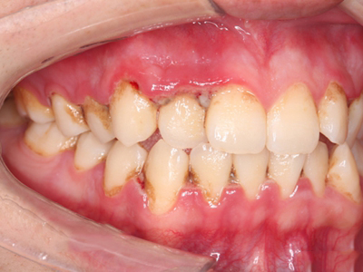 牙龈口腔溃疡根部图片