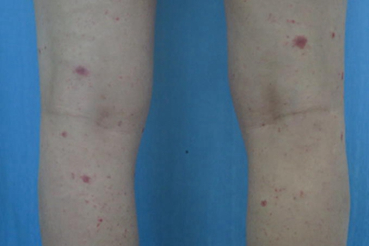 急性痘疮样苔藓样糠疹大腿症状图