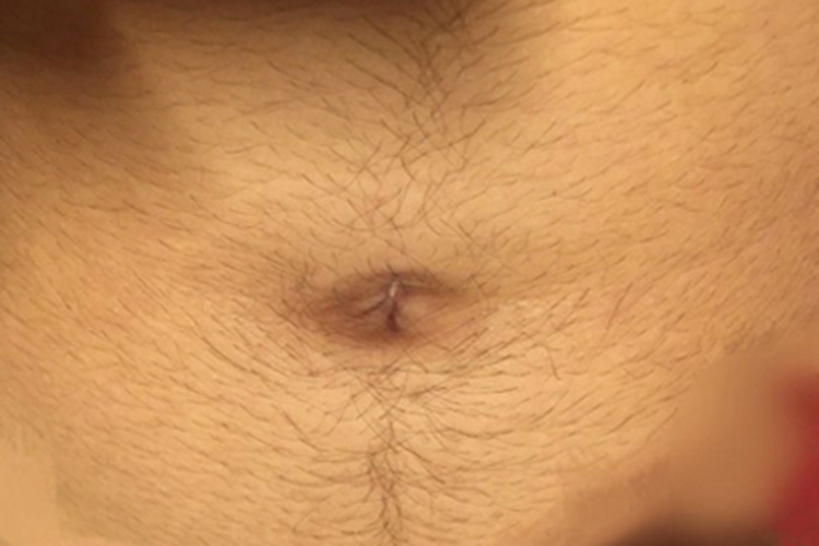 妇女多毛症肚子上长毛图