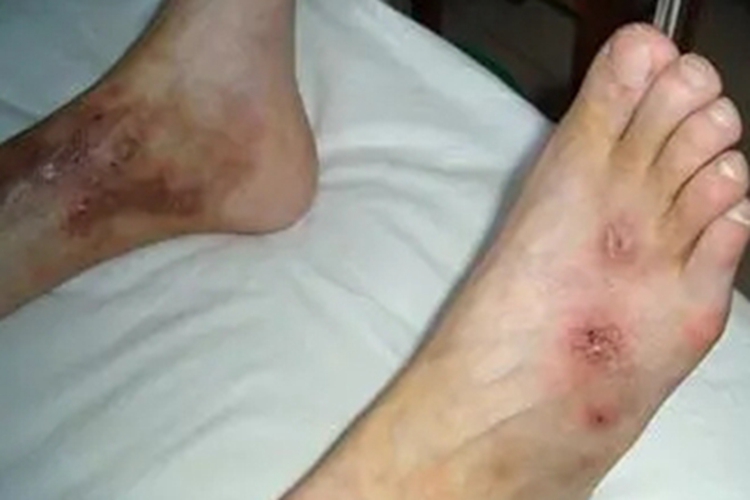 结节性血管炎脚背溃疡图