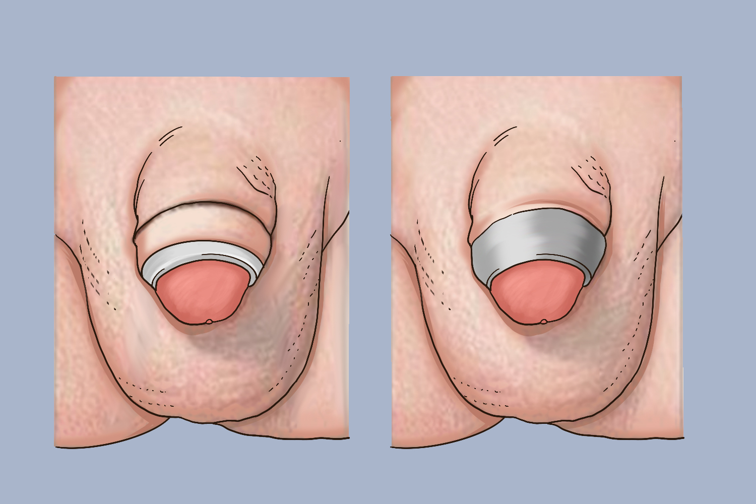 儿童包茎手术后掉环图