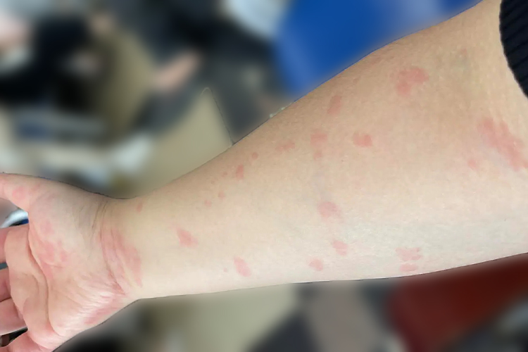艾滋病初期手臂荨麻疹图 艾滋病初期手臂荨麻疹图