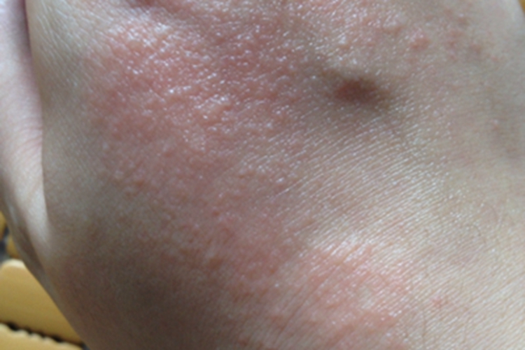 柯萨奇湿疹手背红色小水疱图