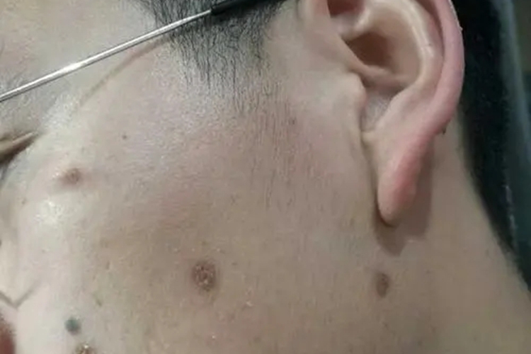 男士激光点痣图