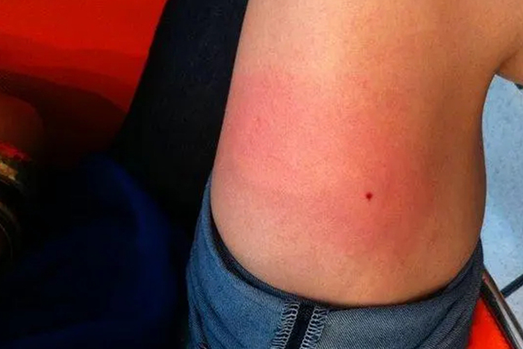大腿被蜂子蜇后局部立即出现明显疼痛,烧灼感及痒感,很快出现红肿