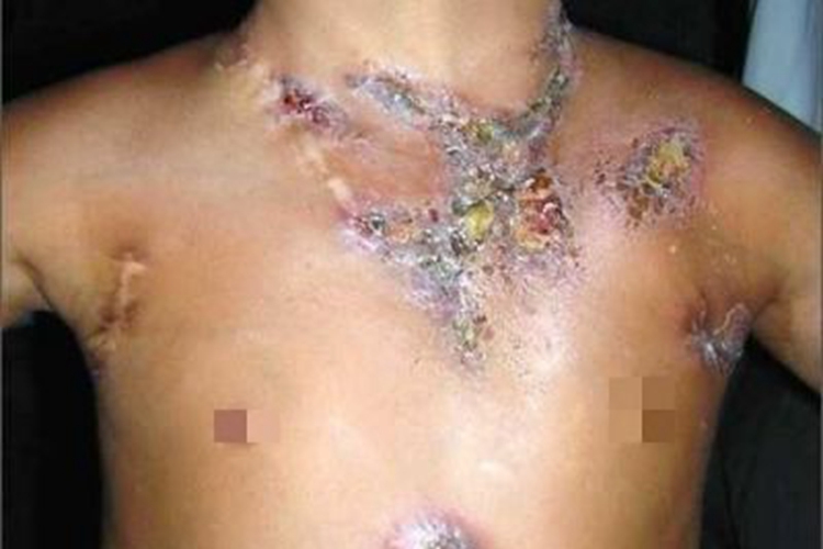 原发性皮肤结核综合征胸部症状图