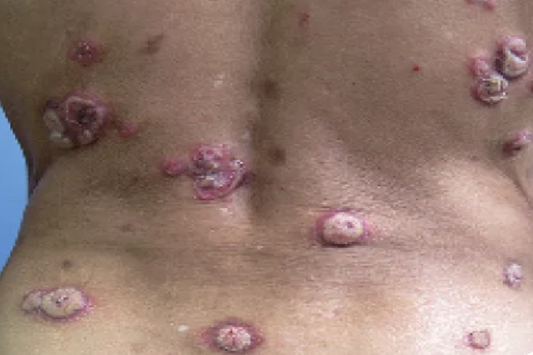 三期梅毒结节性梅毒疹图