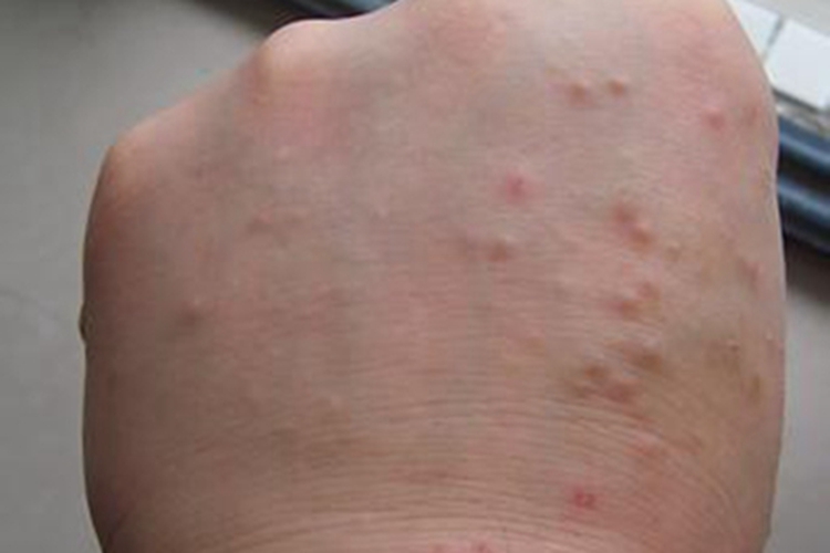 疥疮手背症状图 疥疮手背症状图