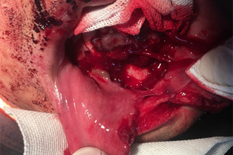 裂伤嘴唇症状图 裂伤嘴唇症状图