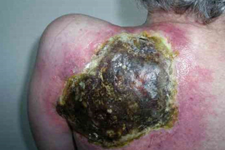 Ⅲ度急性放射性皮炎症状图