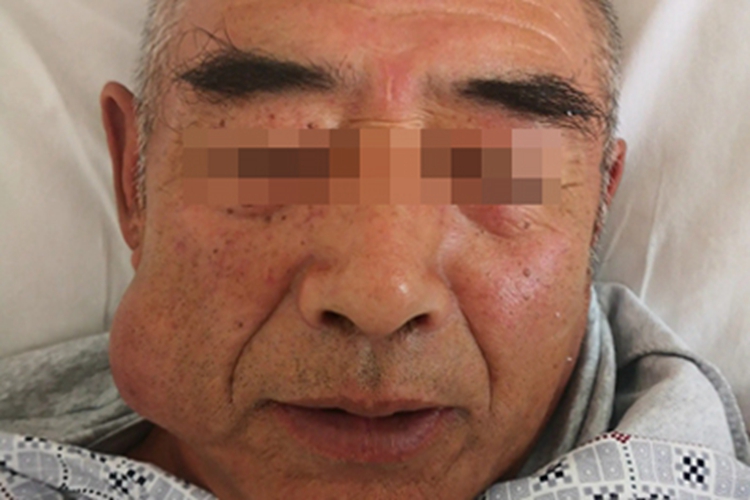 毛发囊肿面部囊肿图