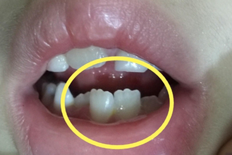 乳牙滞留症状图 乳牙滞留症状图