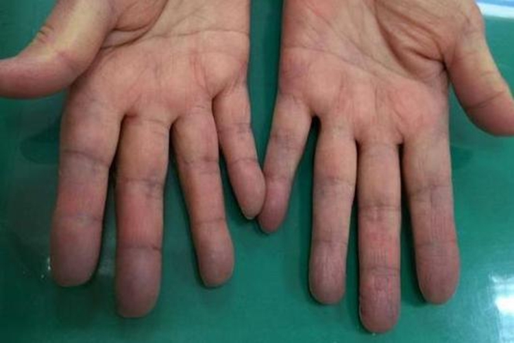 过敏严重手部发绀图 过敏严重手部发绀图