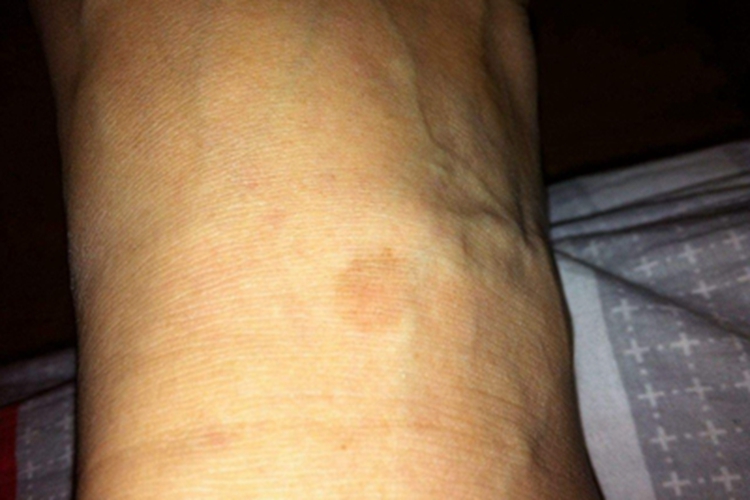 进行性色素性紫癜性皮病脚背斑图