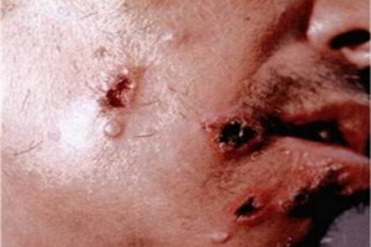 炭疽病面部症状图