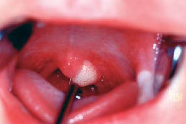 悬雍垂旁边表皮样囊肿图