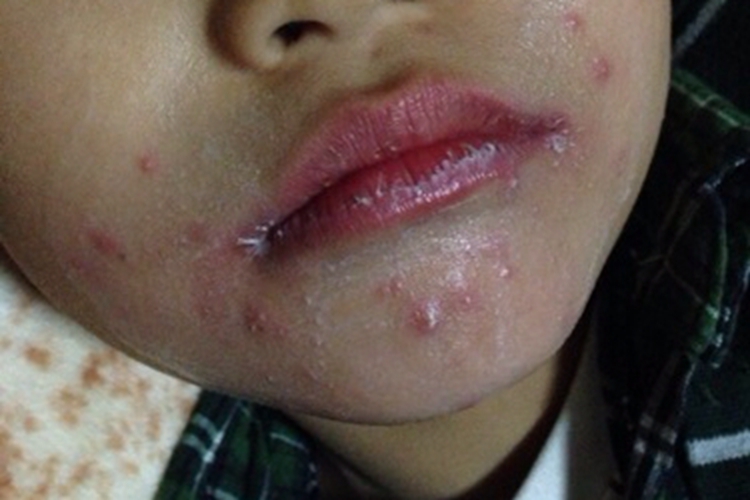 食物过敏小疙瘩图