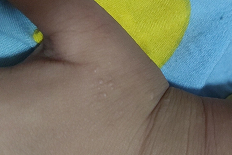 寻常疣手背小疙瘩图