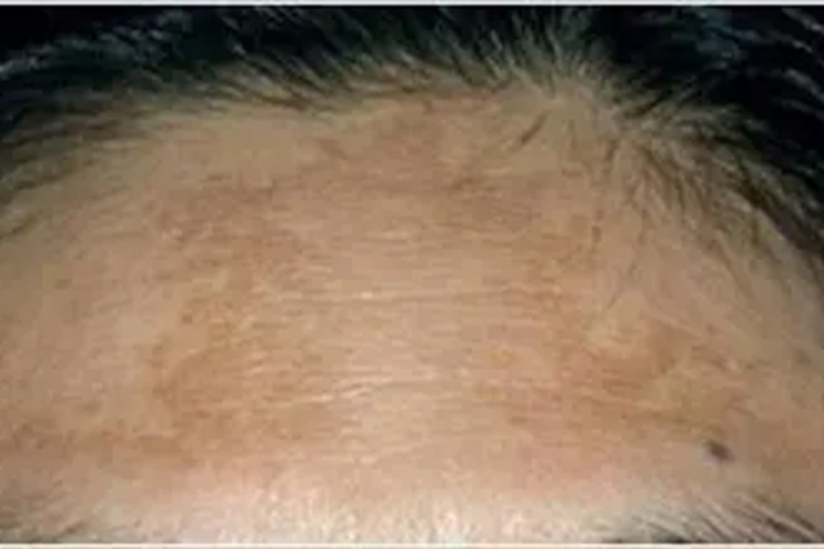 黄褐斑前额症状图