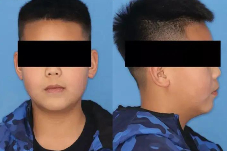 口外弓矫正后效果图